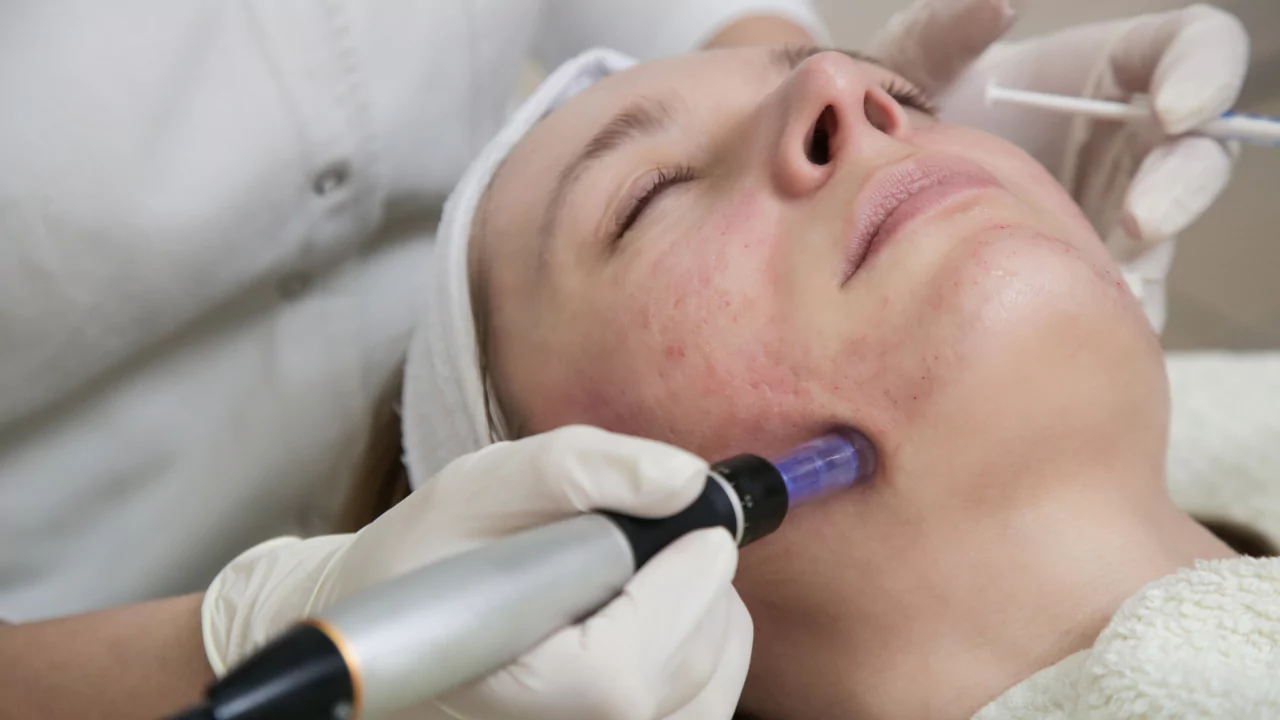 PRP MICRO NEEDLING NEAR ME